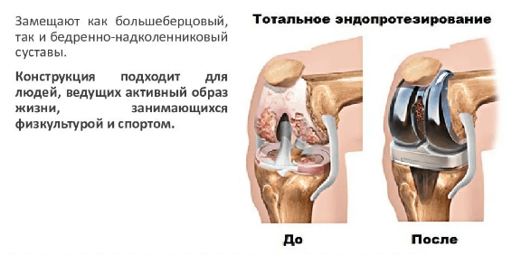 Тотальное эндопротезирование коленного сустава