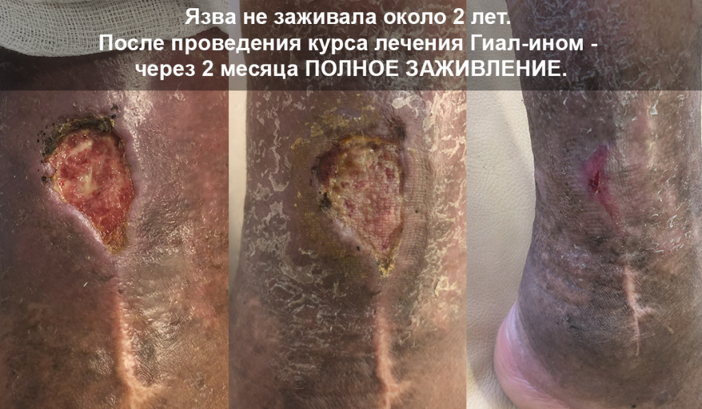 Язва не заживала около двух лет. После проведения курса лечения гиал-ином - через два месяца полное заживление. Язва не заживала около двух лет. После проведения курса лечения гиал-ином - через два месяца полное заживление.